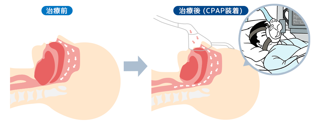 持続陽圧呼吸器（CPAP：シーパップ）